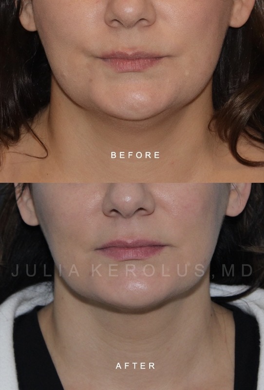Facial Contouring Before & After Image