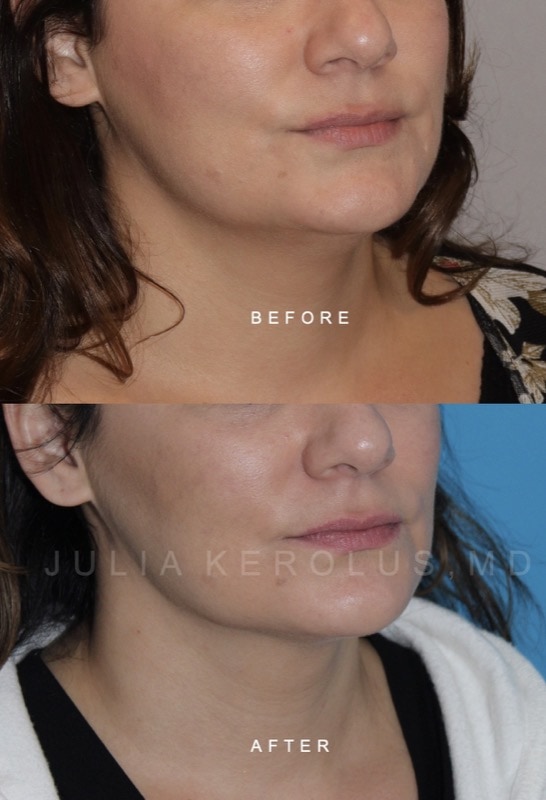 Facial Contouring Before & After Image