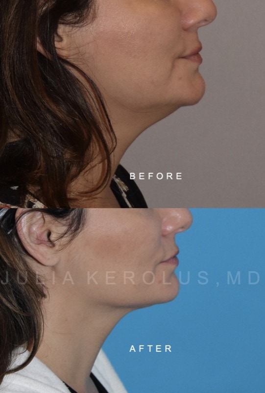 Facial Contouring Before & After Image