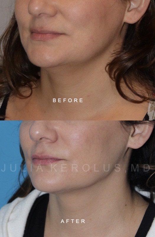 Facial Contouring Before & After Image