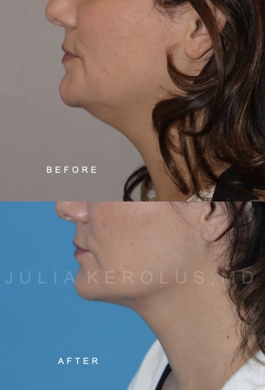 Facial Contouring Before & After Image