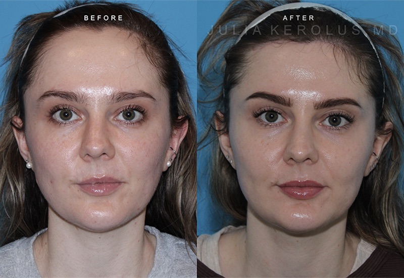 Hairline Lowering Before & After Image