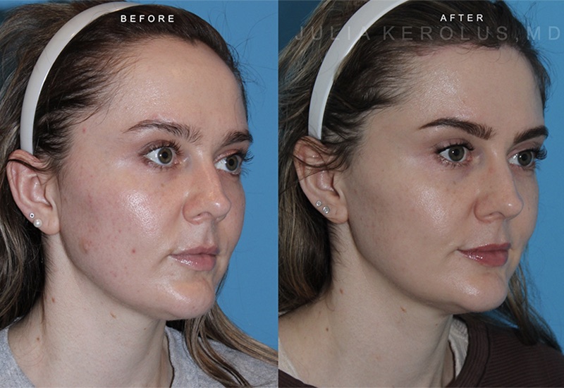 Hairline Lowering Before & After Image