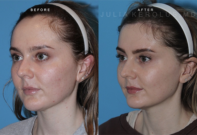 Hairline Lowering Before & After Image