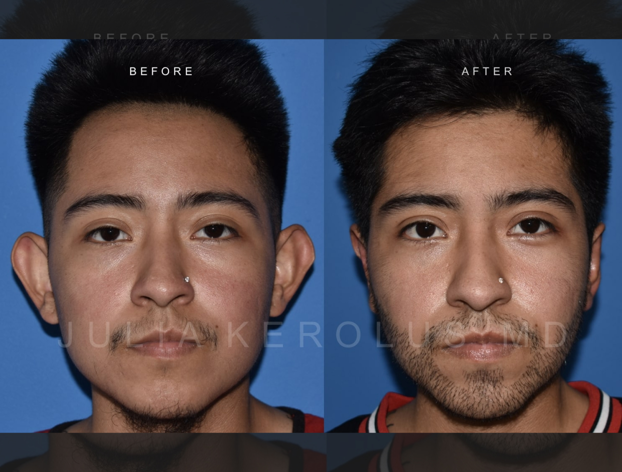 Otoplasty Before & After Image