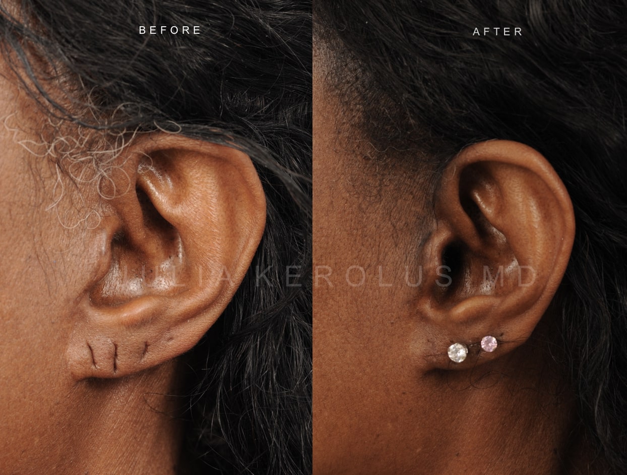 Otoplasty Before & After Image