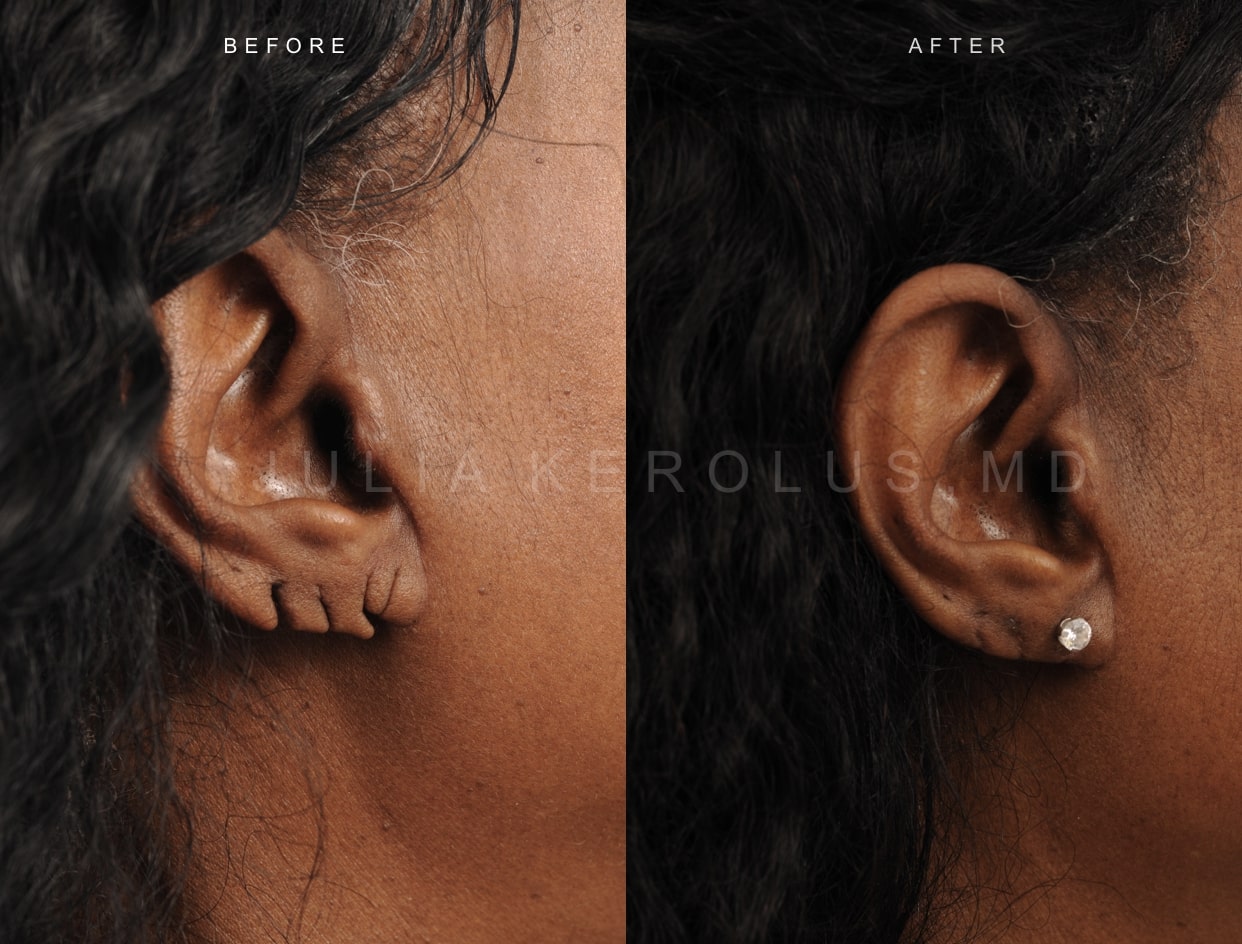 Otoplasty Before & After Image