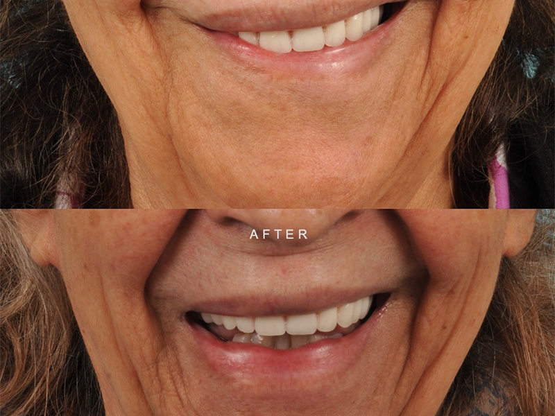 Reanimation Surgery Before & After Image