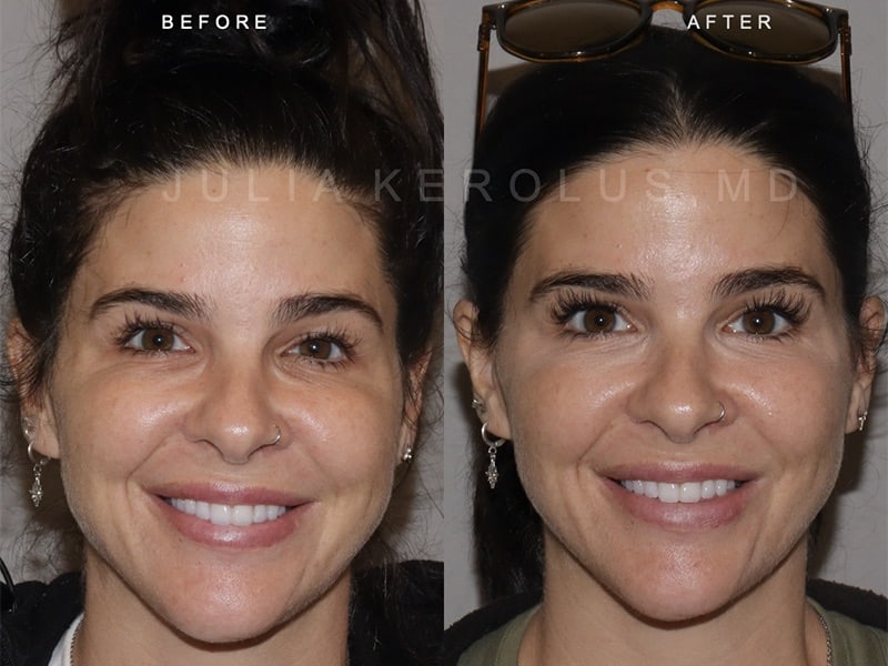 Reanimation Surgery Before & After Image
