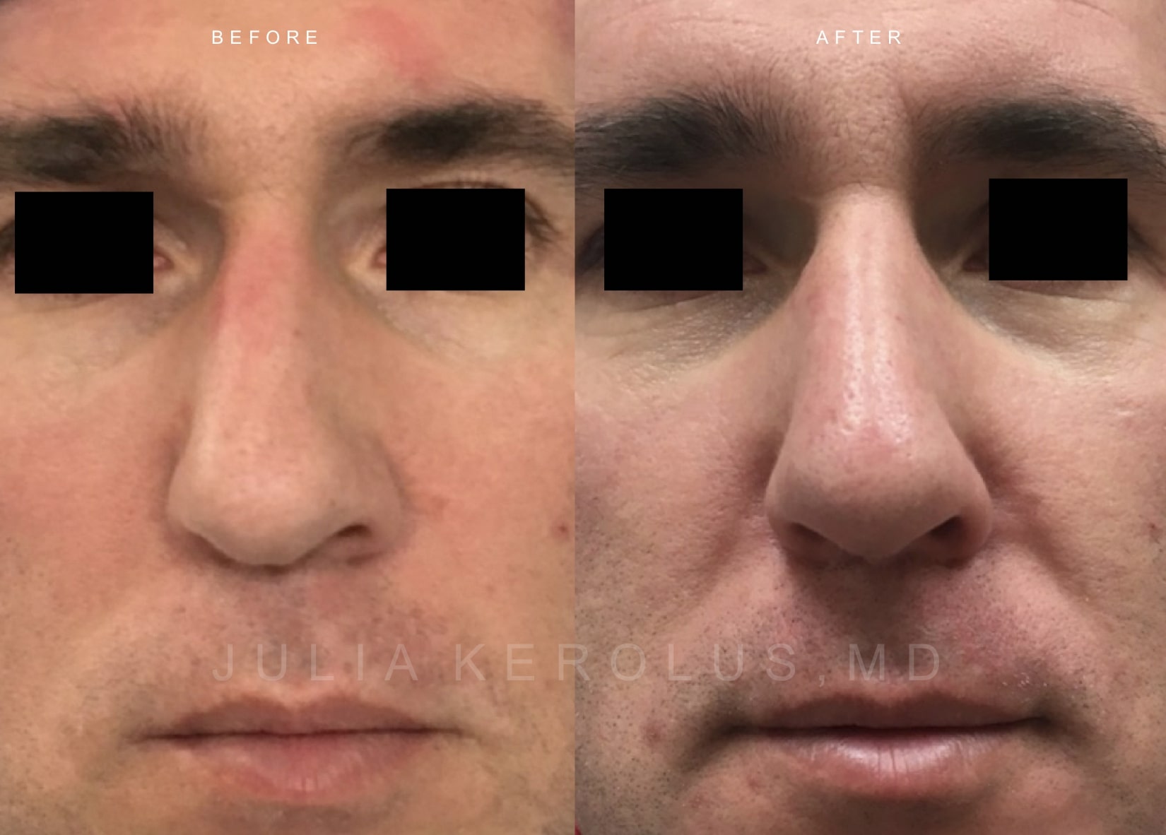 Rhinoplasty Before & After Image
