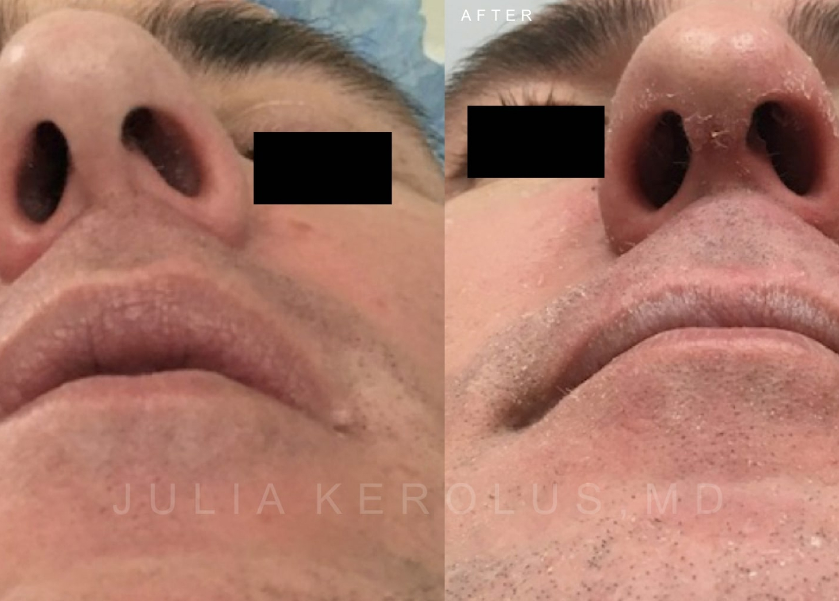 Rhinoplasty Before & After Image