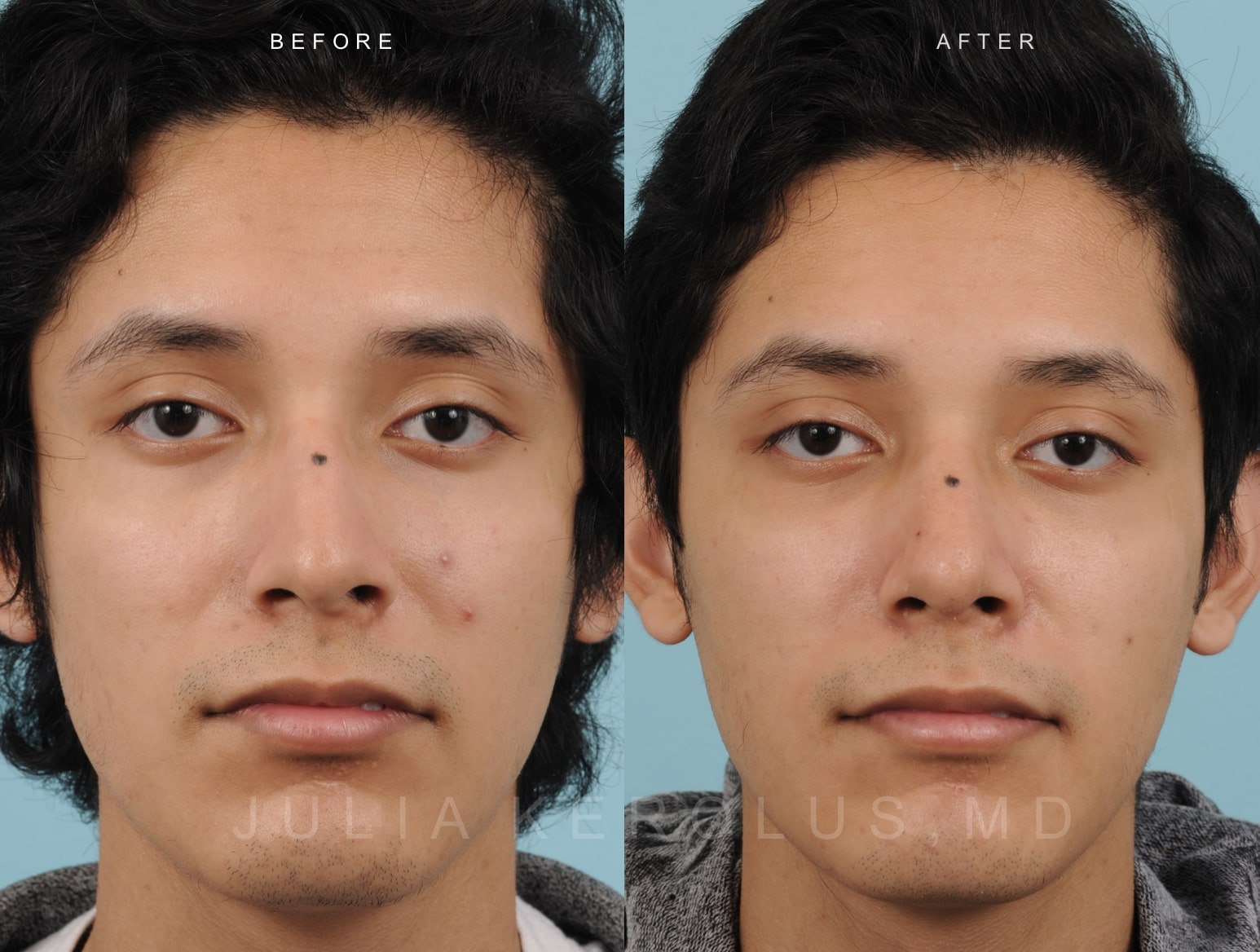 Rhinoplasty Before & After Image