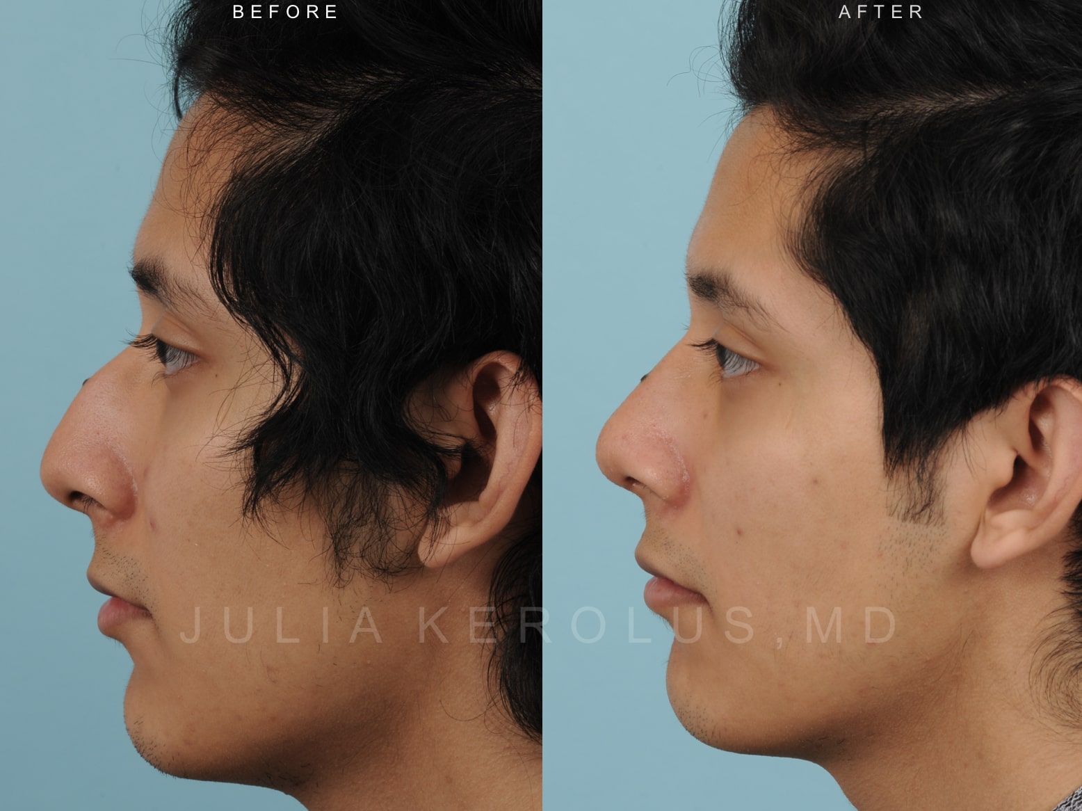 Rhinoplasty Before & After Image