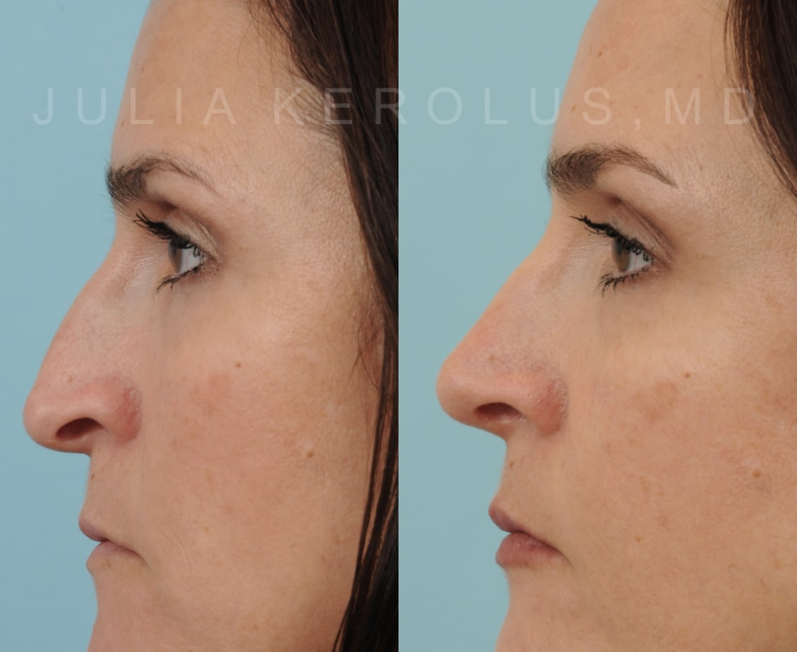 Rhinoplasty Before & After Image