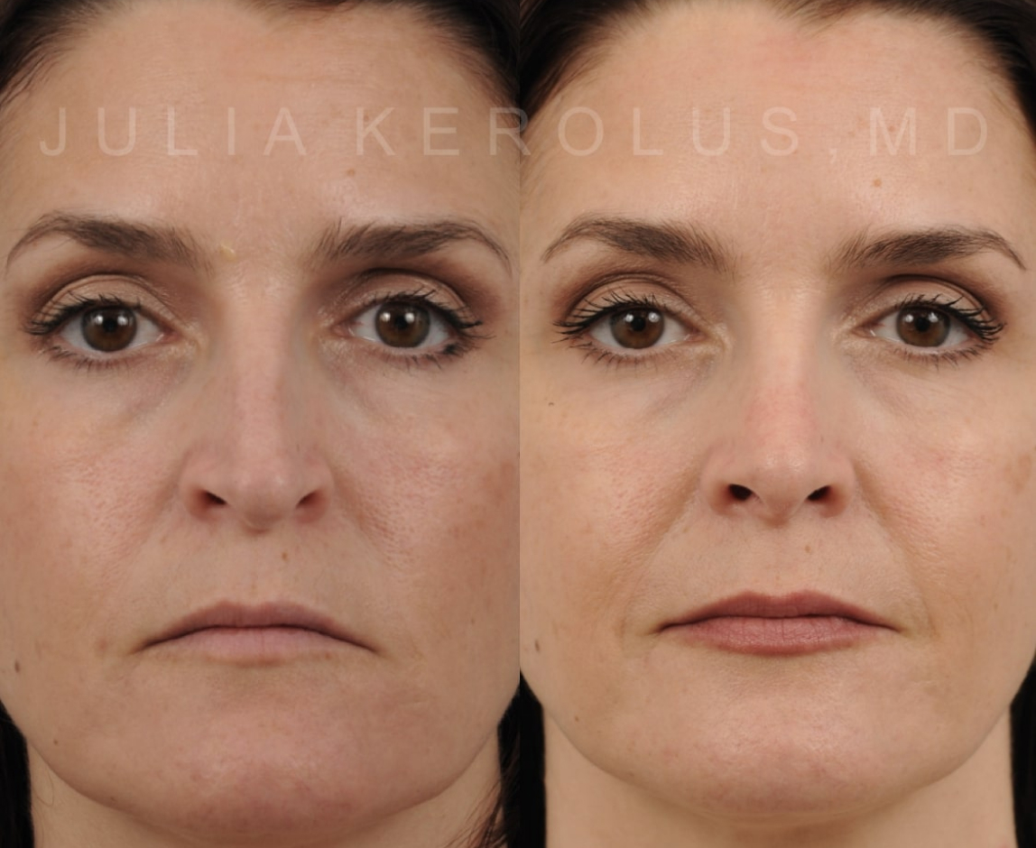 Rhinoplasty Before & After Image