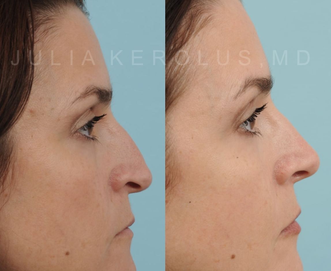 Rhinoplasty Before & After Image