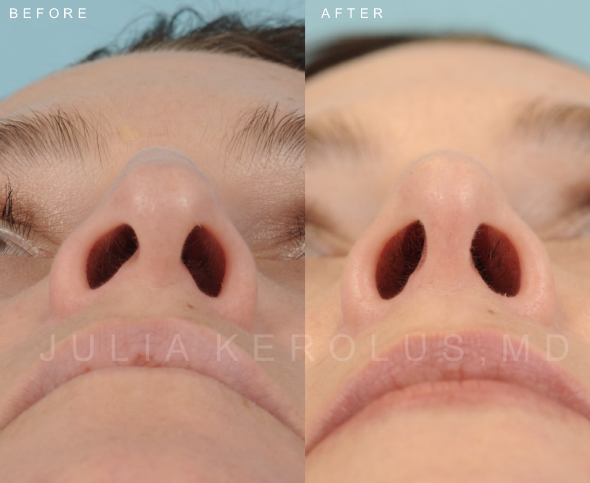 Rhinoplasty Before & After Image