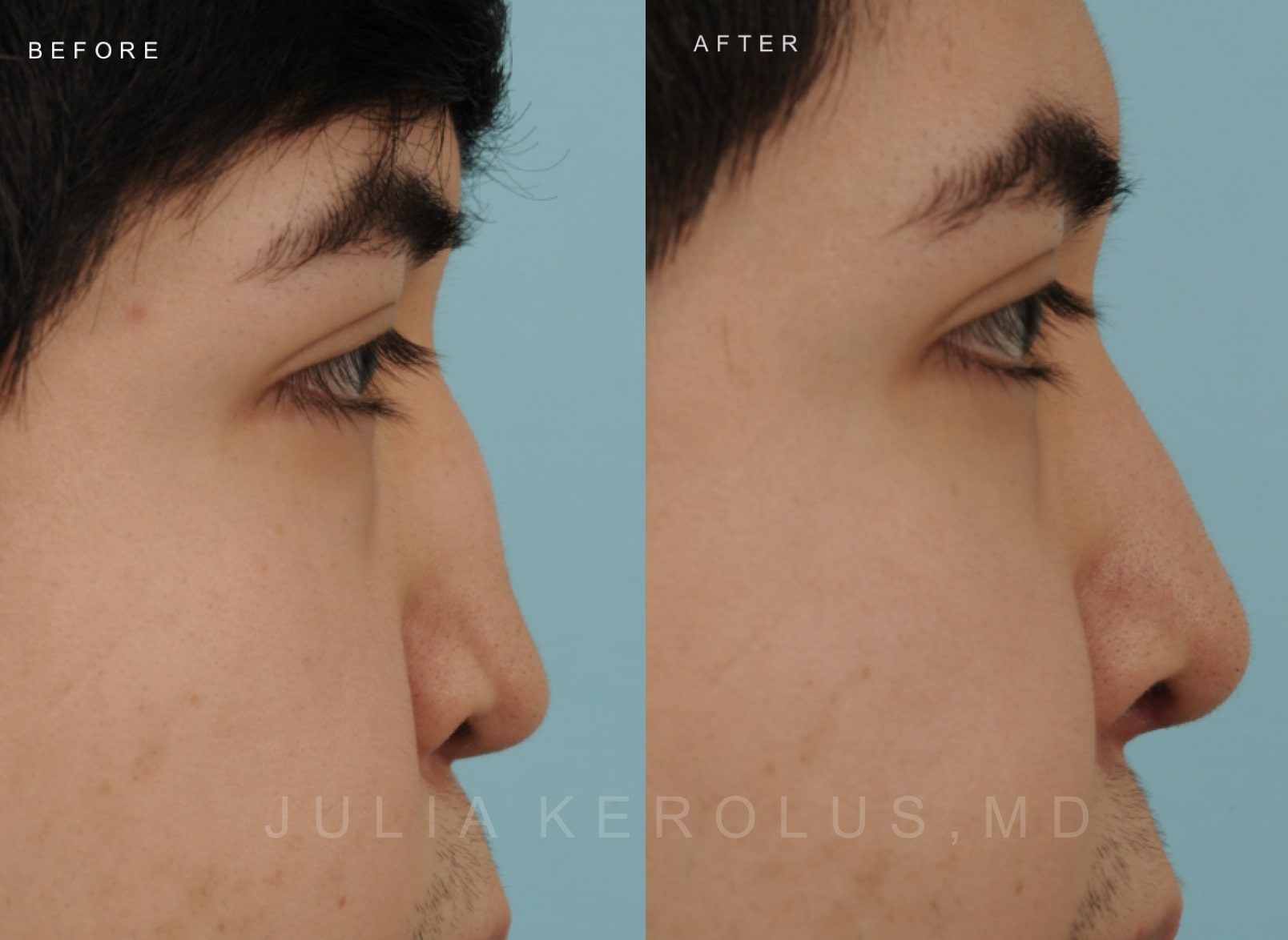 Rhinoplasty Before & After Image
