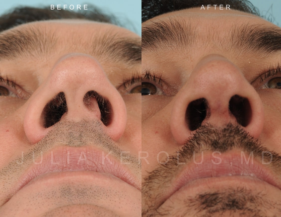 Rhinoplasty Before & After Image