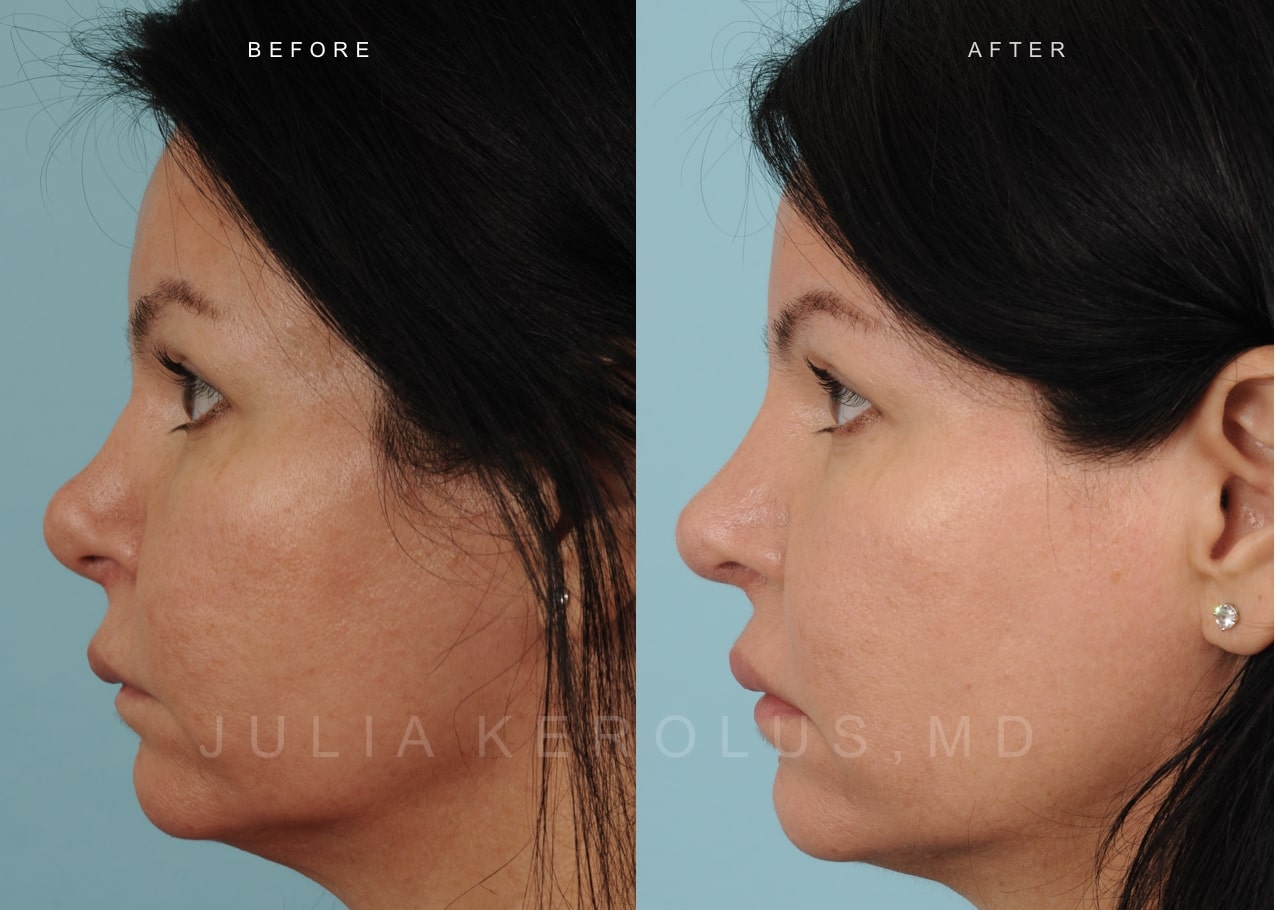 Rhinoplasty Before & After Image