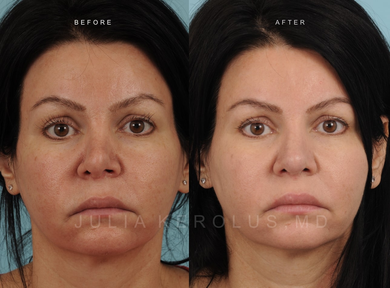 Rhinoplasty Before & After Image