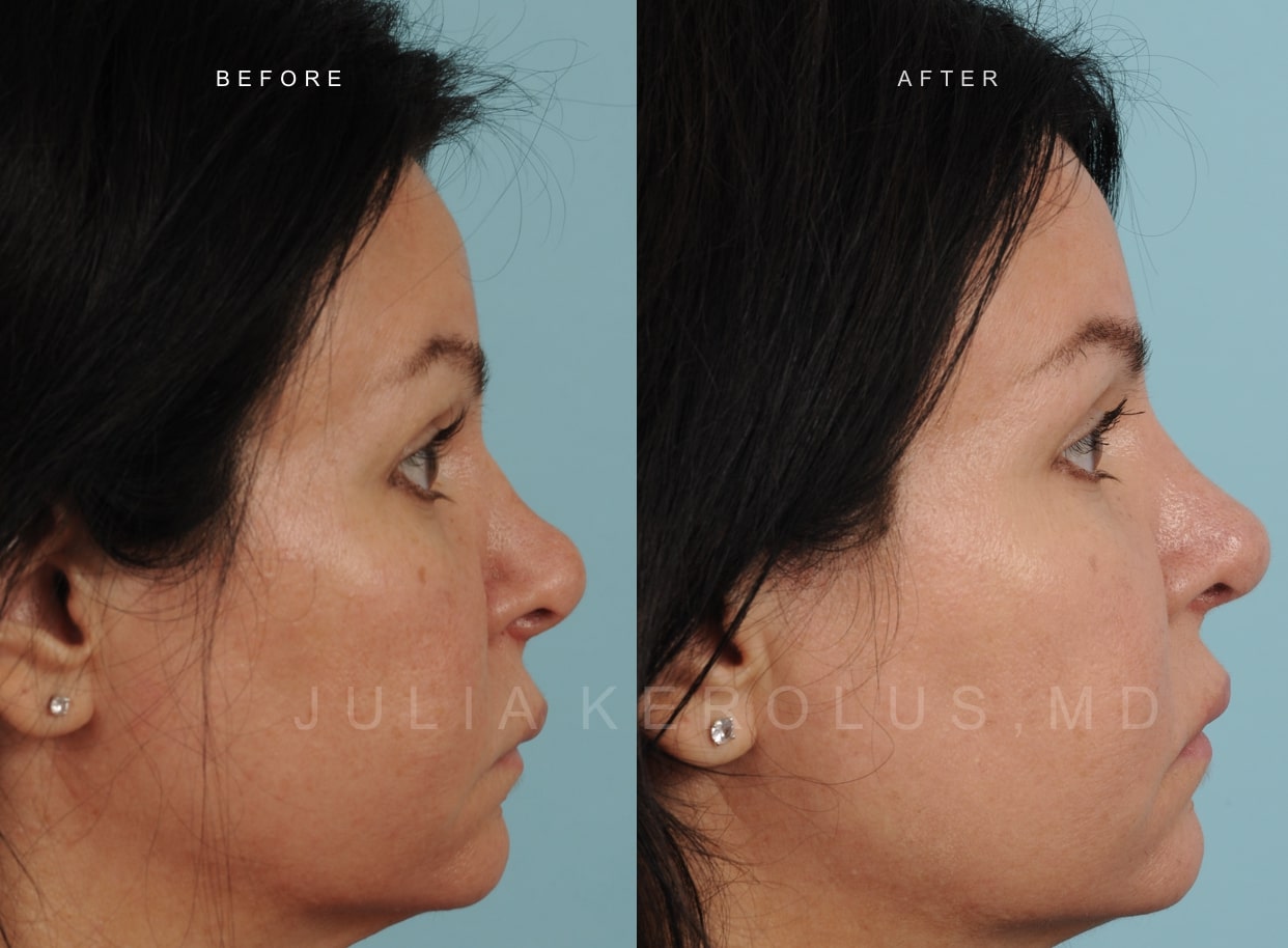 Rhinoplasty Before & After Image