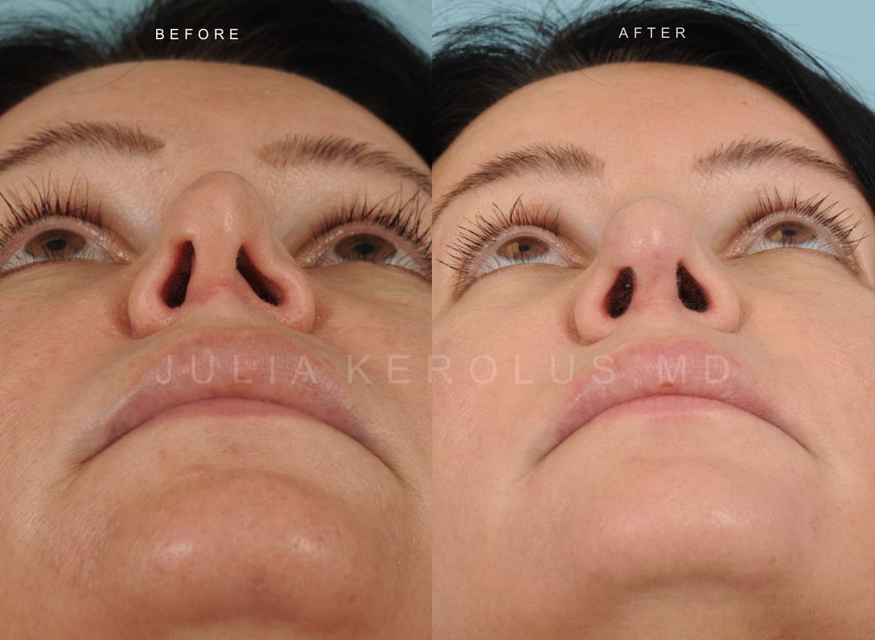 Rhinoplasty Before & After Image