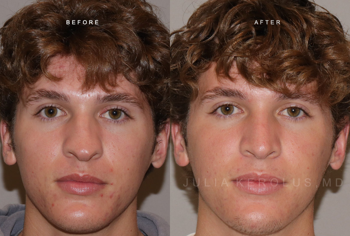Rhinoplasty Before & After Image