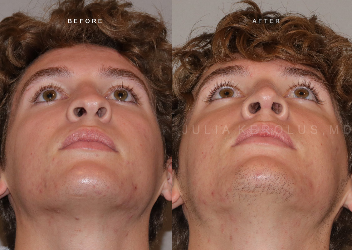 Rhinoplasty Before & After Image