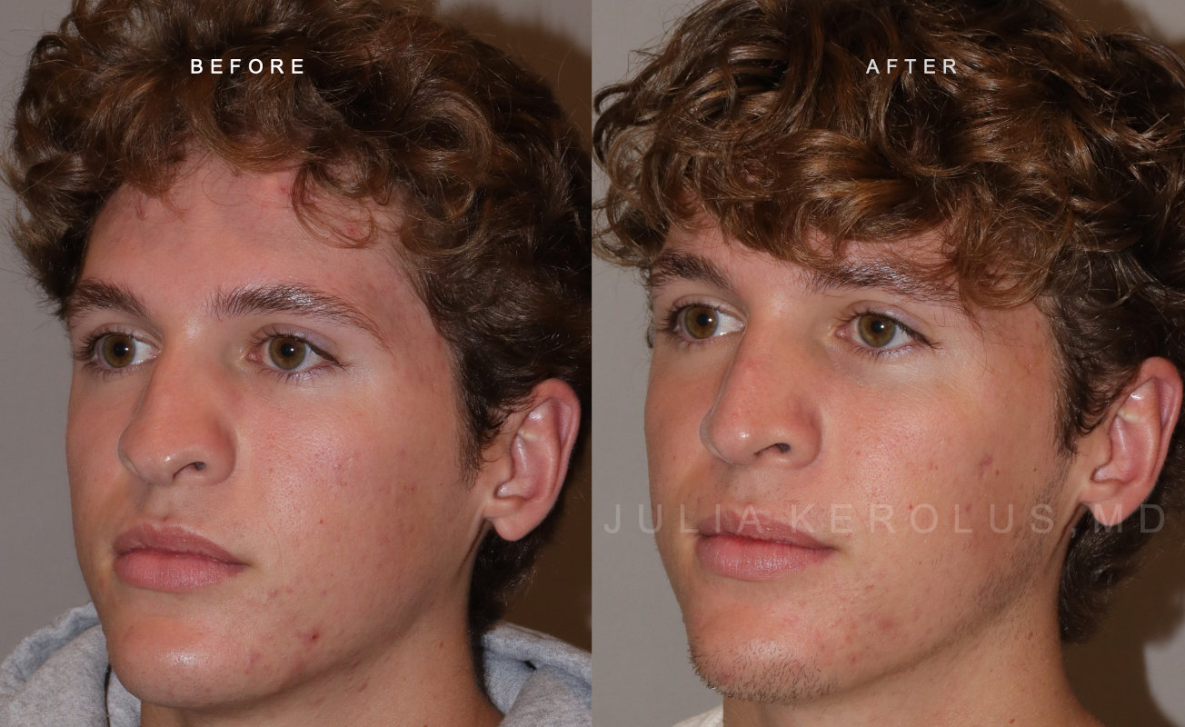 Rhinoplasty Before & After Image