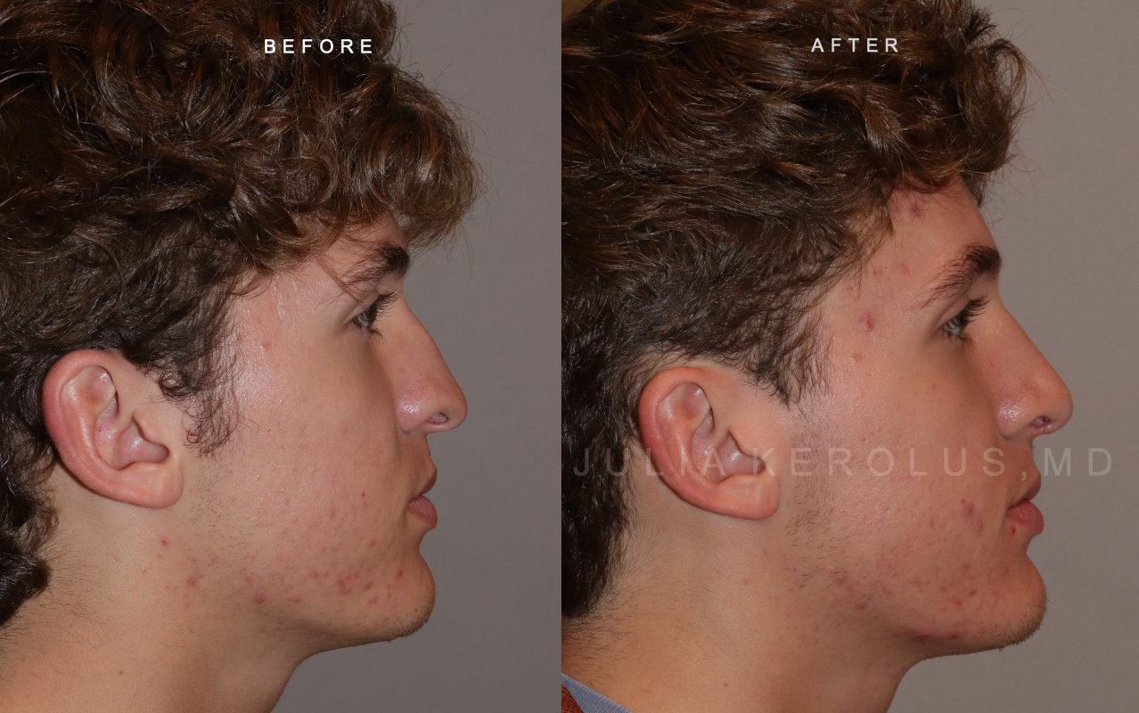 Rhinoplasty Before & After Image