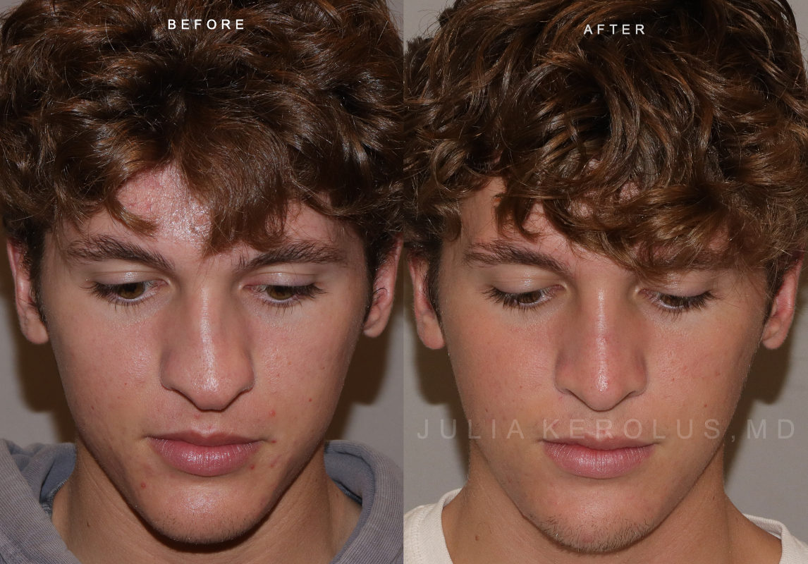 Rhinoplasty Before & After Image