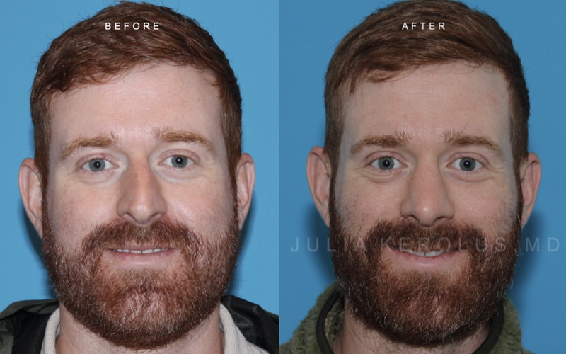 Rhinoplasty Before & After Image