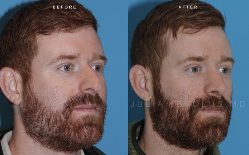 Rhinoplasty Before & After Image