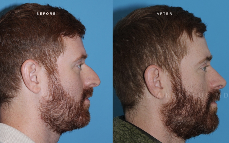 Rhinoplasty Before & After Image