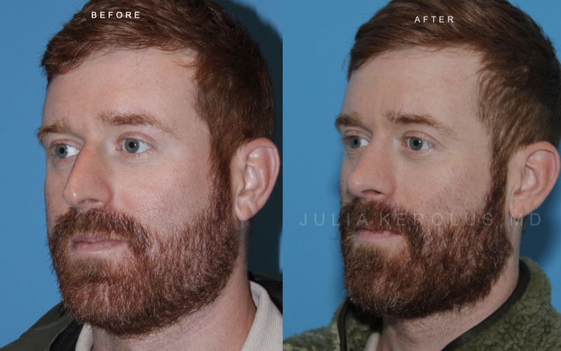 Rhinoplasty Before & After Image