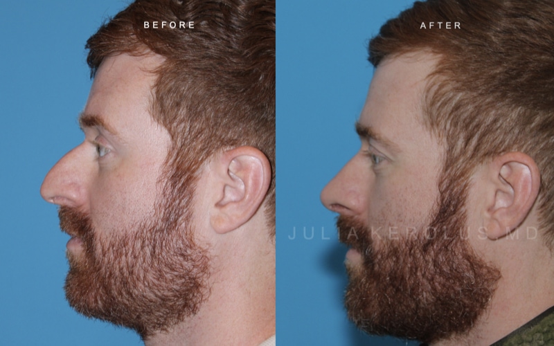 Rhinoplasty Before & After Image